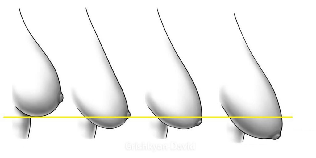 Fold under the breast after mammoplasty: causes and methods of correction