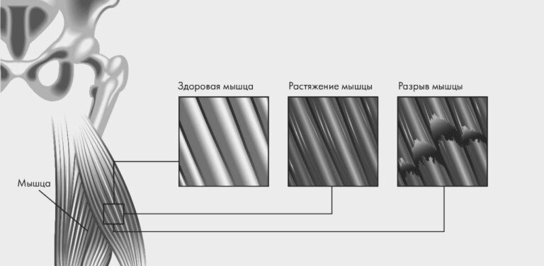 Лечение ушиба тазобедренного сустава