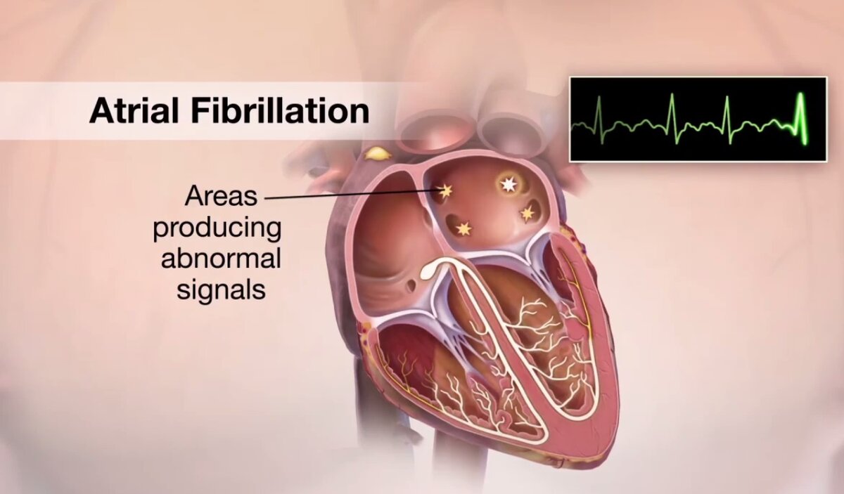 Atrial Fibrillation