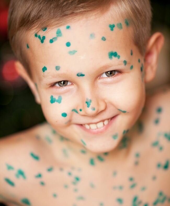 Зеленка как помощник против ветрянки