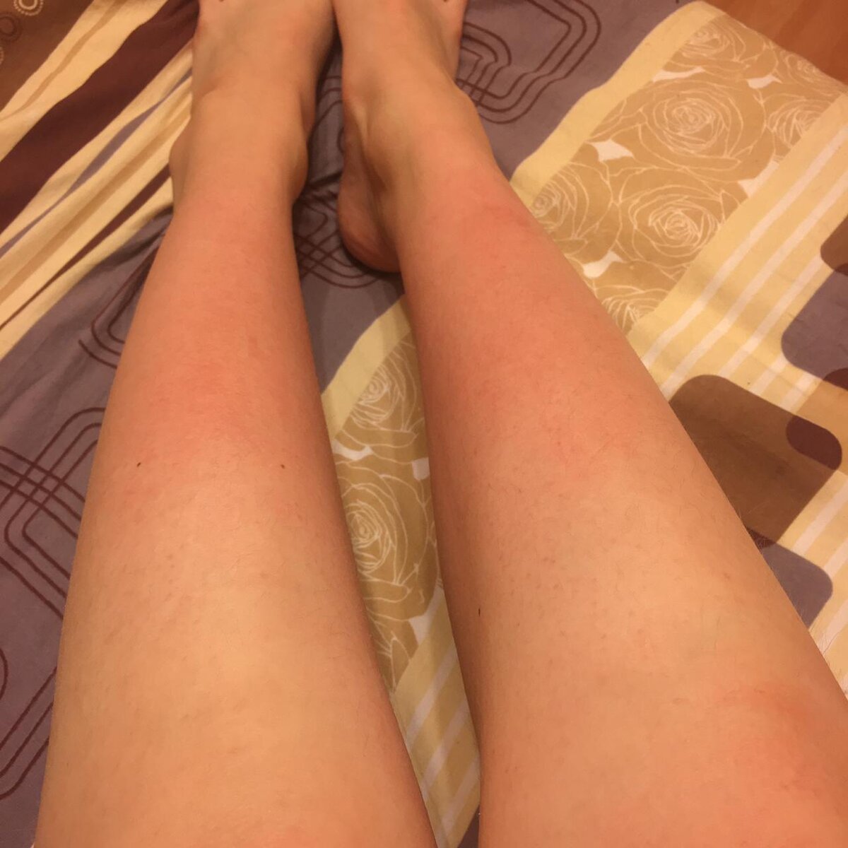  Ножки без отеков. 1 триместр беременности - аллергия на ткань старых брюк.