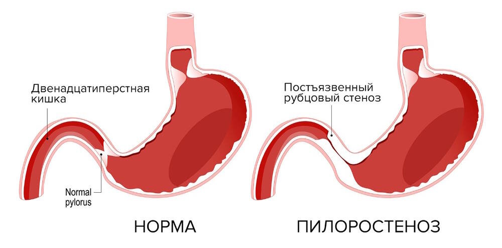 Симптомы, причины и профилактика язвы желудка — блог медицинского центра ОН Клиник