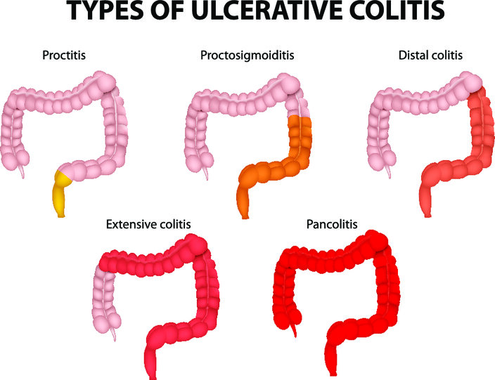 Язвенный колит может поражать разные отделы толстой кишки.