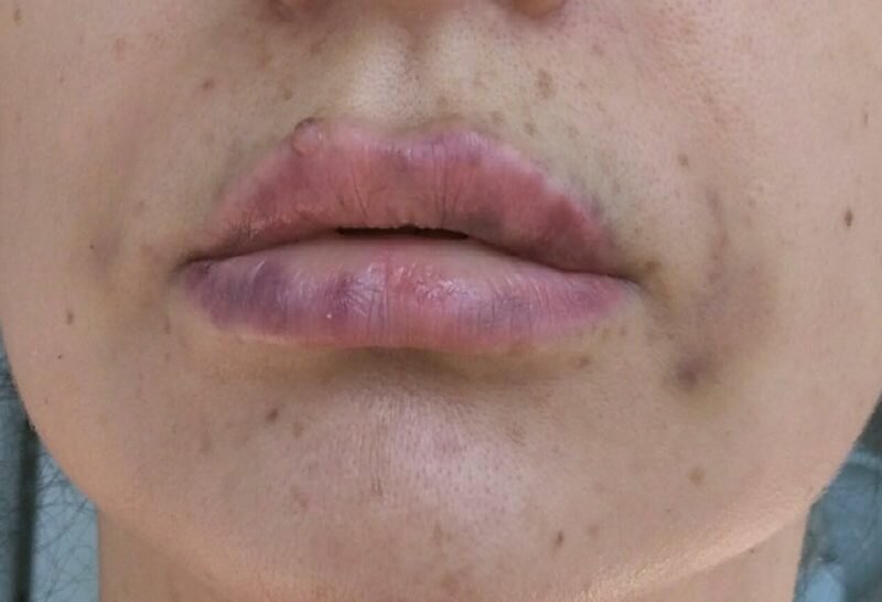 Как убрать уродливый шрам на губе?