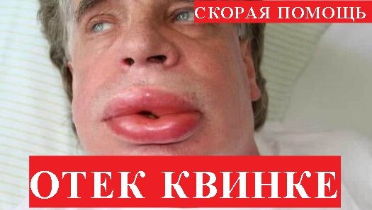 Внимание! Вся информация в видео только для ознакомительных целей! При возникновении каких либо симптомов вызывается скорая медицинская помощь!