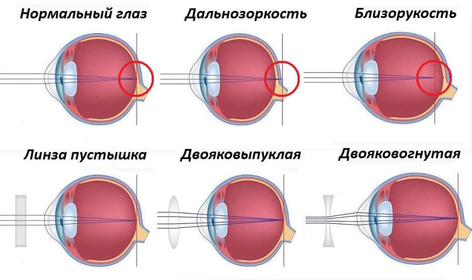 Сколько диоптрий в очках? | Ochkov.net | Дзен