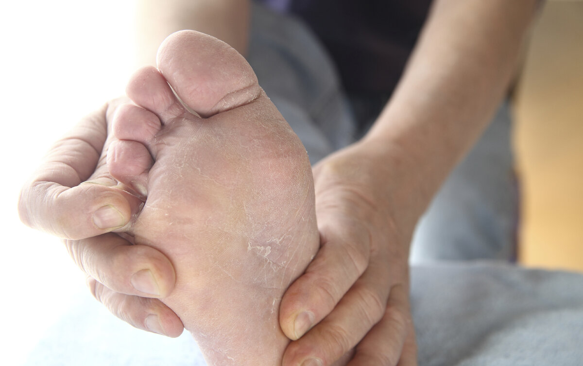 Сухая кожа на ногах: причины и увлажняющие средства