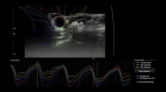 Анализ деформации общей сонной артерии с помощью ПО Arterial Analysis фирмы Samsung Medison, Ю. Корея.