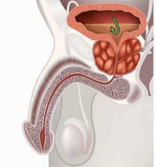 На рисунке воспаленая, увеличенная простата.