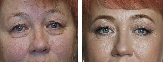 На данном фото брови тоже не выглядят чужеродно. Фото взяла из своей предыдущей статьи о "мешках" под глазами.