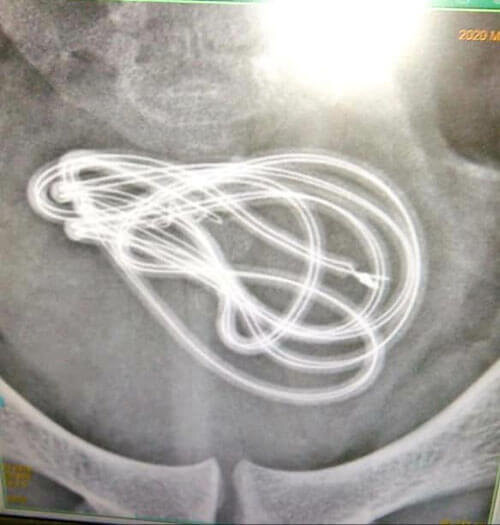 В ходе операции было выяснено что вышеупомянутый шнур находился в МОЧЕВОМ ПУЗЫРЕ!!! Да Да Да,я сам в шоке.  