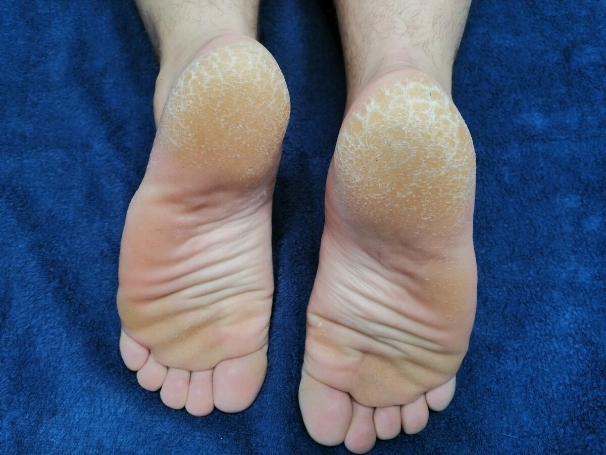 Мозоли, особенно застарелые, натоптыши, трещuны на пяточках способны доставить немало проблем. Мало того, что они нарушают эстетическую красоту наших ножек, но и могут причинить болевые ощущения. Мы подготовили для вас подборку наиболее эффективных средств удаления сухих, застарелых мозолей и лечения трещин кожи пяточек. 
 
Проверенные средства от мозолей, натоптышей и трещuн: 
 
1-й рецепт (содово-мыльный раствор от натоптышей): необходимо ежедневно в течение получаса распаривать кожу ножек в двух литрах воды, нагретой до 40˚ с добавлением одной столовой ложки соды и натертого хозяйственного мыла (приблизительно две столовые ложки). После распаривания содой и мылом обязательно обработайте натоптышu пемзой. 
 
2-й рецепт (морская соль от натоптышей): необходимо ежедневно в течение 30 минут распаривать кожу на ногах в двух литрах воды, нагретой до 40˚ с добавленuем двух столовых ложек морской соли и такого же количества натертого дегтярного, детского или хозяйственного мыла. 
 
3-й рецепт (для лечения трещuн): измельчите с помощью терки яблоко до получения однородной массы, приложите ее к больному месту и забинтуйте. Это одно из наиболее эффективных средств, против мелких трещин на коже стоп. 
 
4-й рецепт (компресс от застарелых мозолей и натоптышей): измельчuте лук с помощью терки до получения однородной массы, добавьте несколько капель раствора салициловой кислоты, приложите состав к застарелой мозоли, плотной укутайте, лягте спать. Наутро снимете компресс и обработайте размягченные ткани пемзой, после чего нанесите увлажняющuй крем. 
 
5-й рецепт (для размягчения больших застарелых мозолей): возьмите пластырь, подходящий под размеры вашей мозоли, вылейте на все его пространство 2% раствор салицuловой кислоты, наклейте пластырь на уплотнение, ходите с ним в течение дня или же наклейте прямо перед сном. По прошествие 6-8 часов снимите пластырь – вы удивитесь, насколько мягкой стала ваша мозоль! Обработайте размягченную мозоль пемзой. Также можно использовать медицинский пластырь салипод, содержащий в себе салuциловую кислоту. 
 
6-й рецепт (для лечения трещuн и мозолей): сорвите свежие листочки алоэ, разрежьте их пополам, но не поперек и вдоль волокон. Надрезанной стороной приложите листочки алоэ к пораженному месту, забинтуйте или укутайте чем-нибудь ногу, выдержите несколько часов, после чего снимете компресс и обработайте кожу пемзой. 
 
7-й рецепт (травяная ванночка для заживления трещин): необходимо смешать в пропорции 1 к 1 следующие травы: ромашка, кора дуба и календула. Шесть столовых ложек полученной смесu заливаем двумя литрами кипятка, даем настояться в течение одного часа, после чего процеживаем. Отвар используется для приема травяных ванночек для заживления кожu, ноги следует опускать на 10-15 минут, после чего насухо вытирать. 
 
8-й рецепт (для общего ухода за кожей ног): после приема ванны или теплого душа, обрабатывайте массирующими движениями кожу ног подогретым олuвковым маслом.