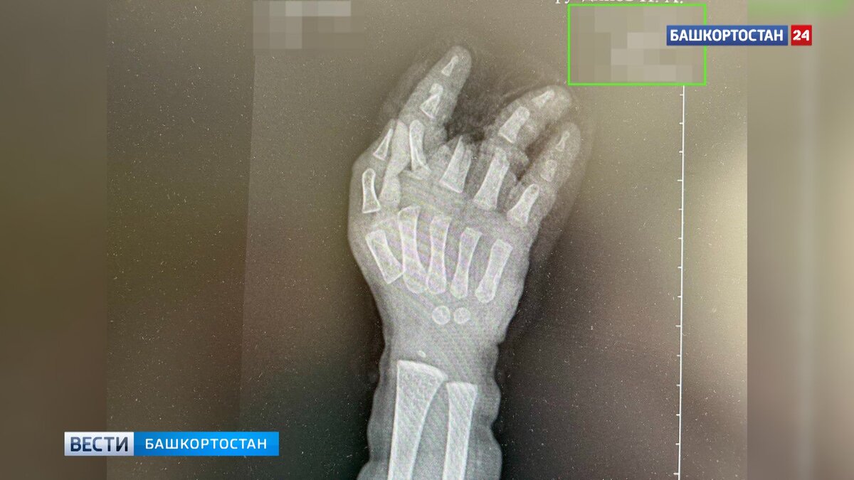    В Башкирии годовалый мальчик засунул руку в работающую мясорубку