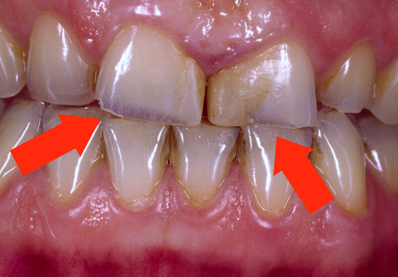Стираемость эмали зубов