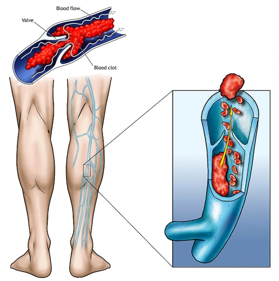 Узел на вене. Варикозная болезнь и тромбофлебит.