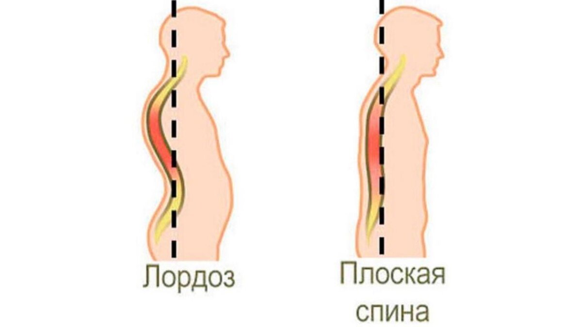 Что такое лордоз. Лордоз поясничного отдела у ребенка. Прямой лордоз поясничного отдела. Плоская спина. Круглая плоская спина.
