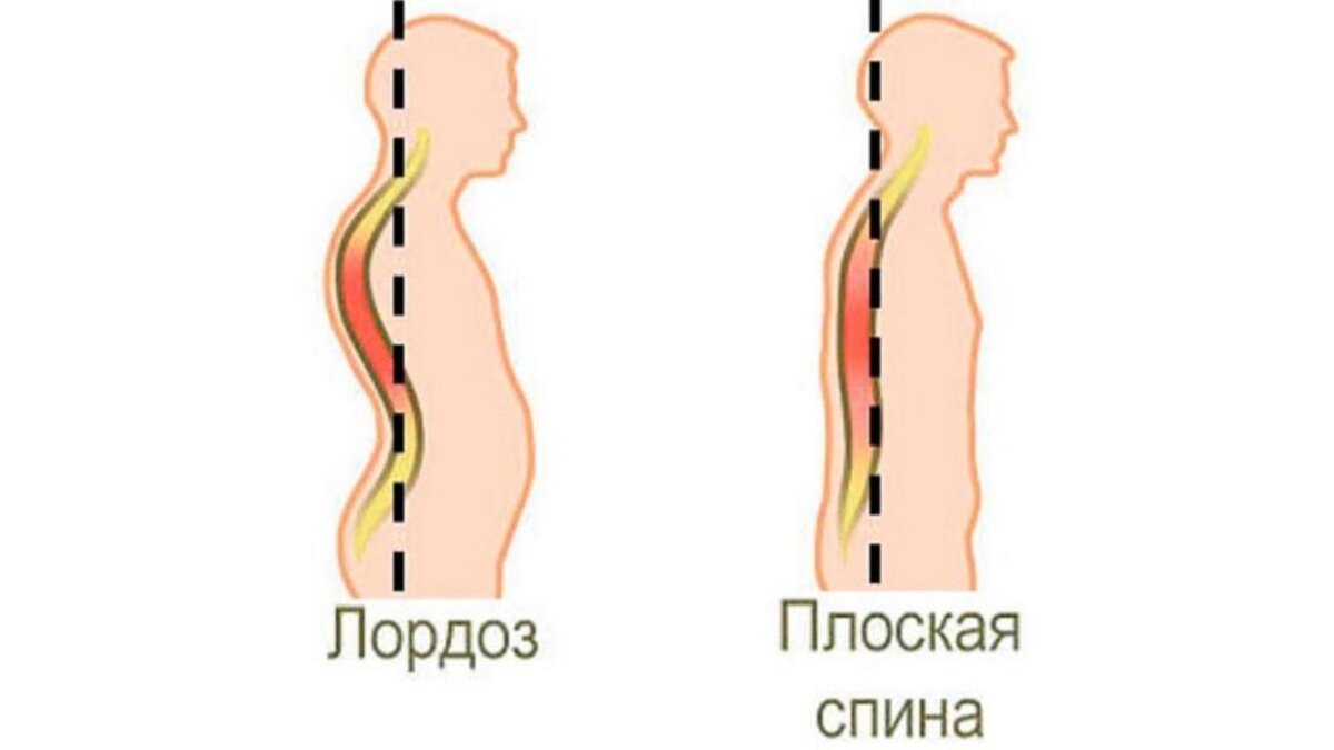 Грудной лордоз фото