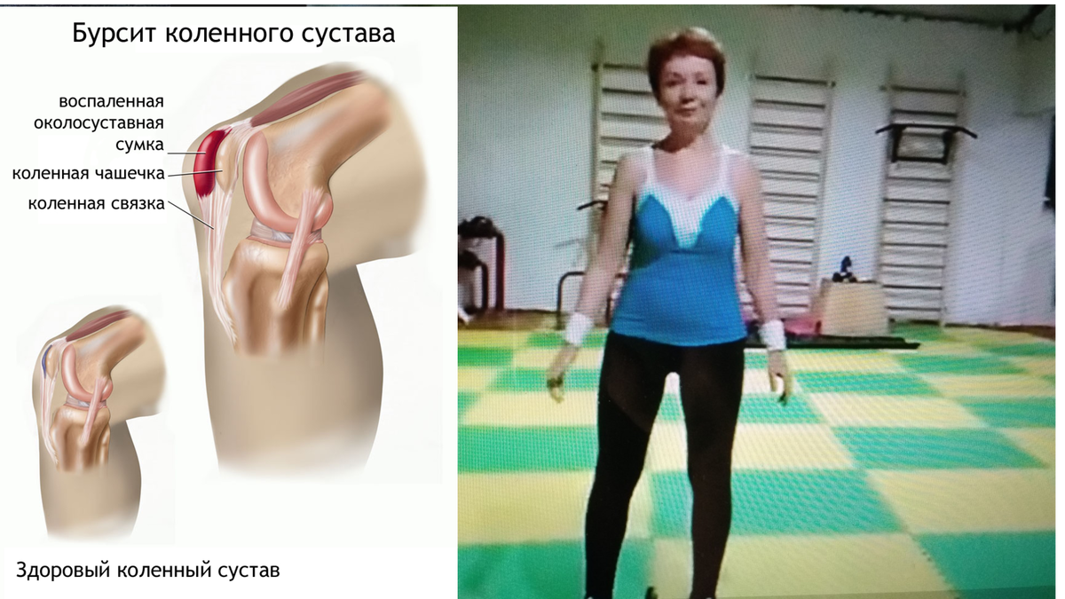 Так выглядит бурсит на рисунке. Справа моя жена Лара на тренировке с гирями.