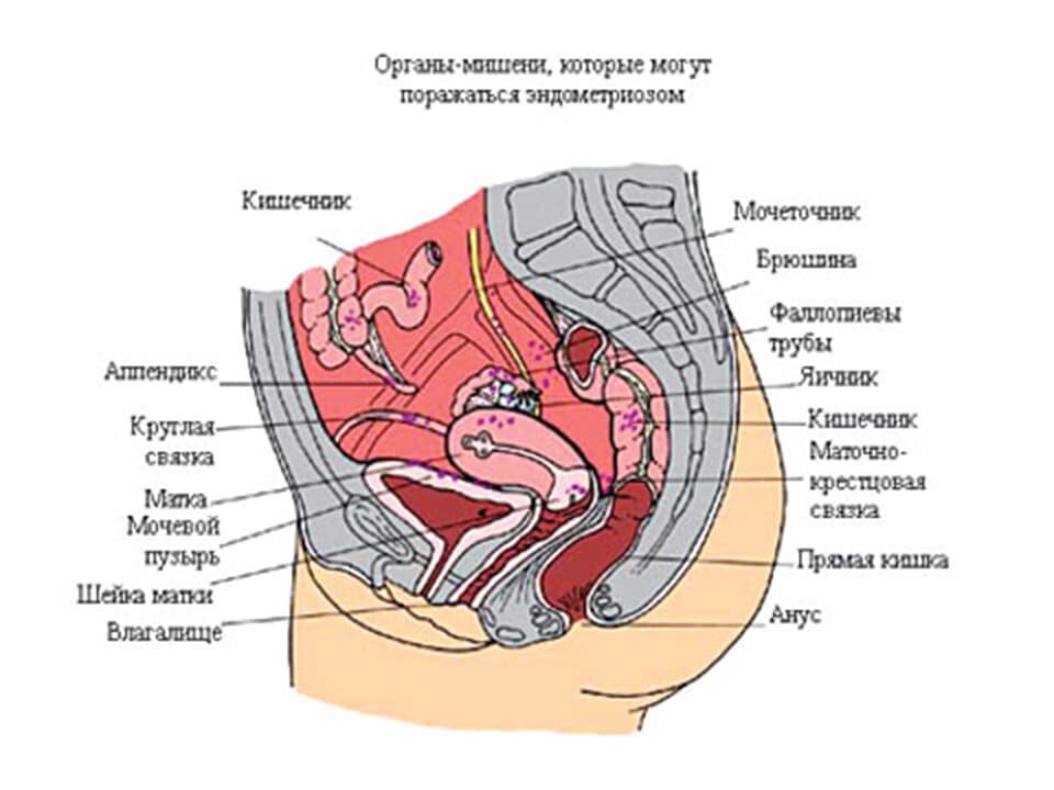 Особенности лечения эндометриоза боровой маткой