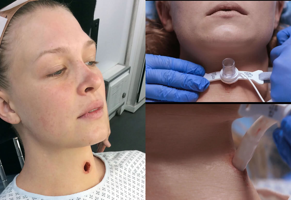 Трахеостома