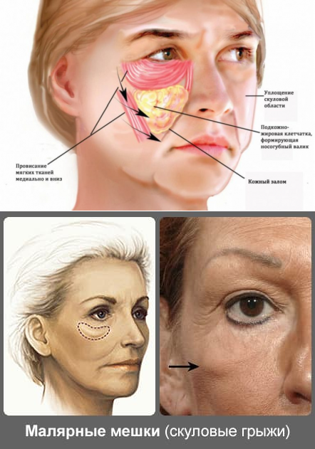 Болят кости на лице. Носослезная борозда малярный мешок. Малярные мешки под глазами суфы. Малярные мешки на скулах. Суфы на лице под глазами.