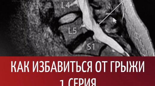 Как избавиться от грыжи? 1 сезон 1 серия | Реабилитация ONLINE | Дзен
