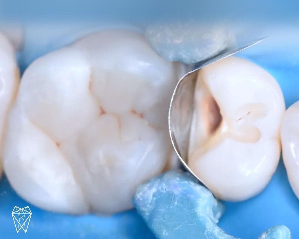 Случай из практики: пломба-терминатор | Стоматология Belgravia Dental ...