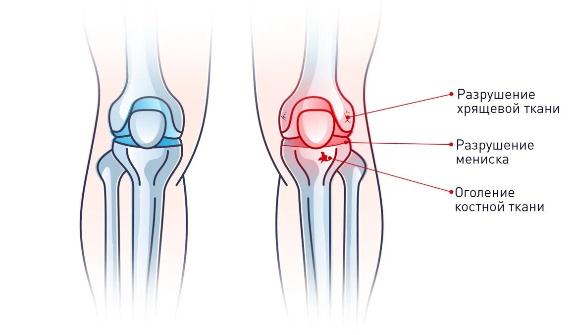 3-4 степень гонартроза