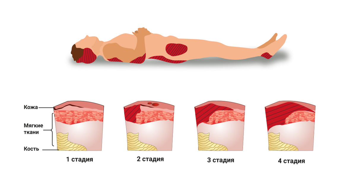 Как лечить пролежни