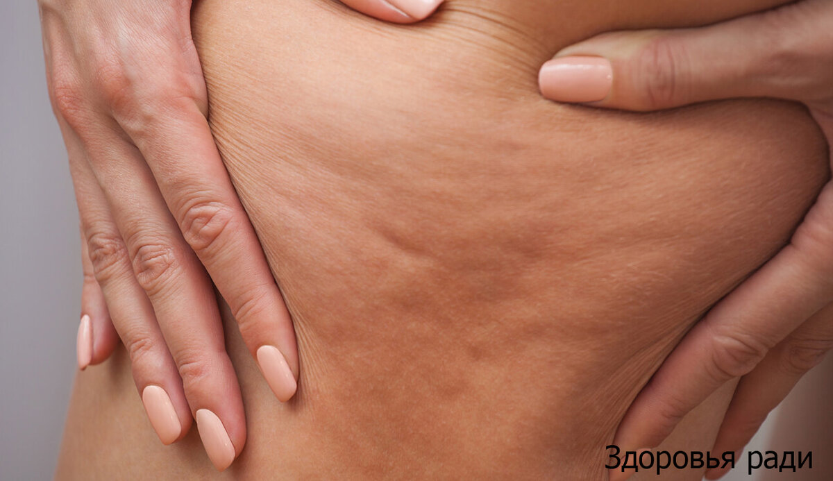 Борьба с целлюлитом. Фото взято из открытых источников