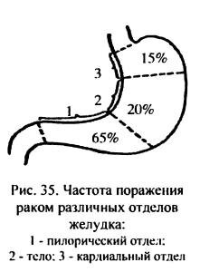 Схема рак желудка