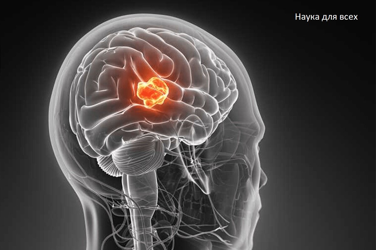 Опухоль головного мозга это. Опухоли центральной нервной системы. Злокачественное новообразование головного мозга.