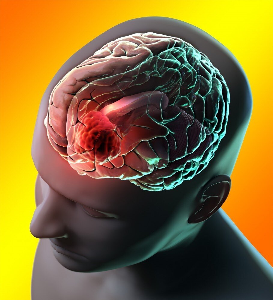 Опухоли мозга (менингиома);