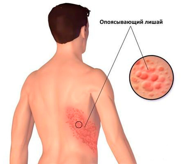 Опоясывающий лишай