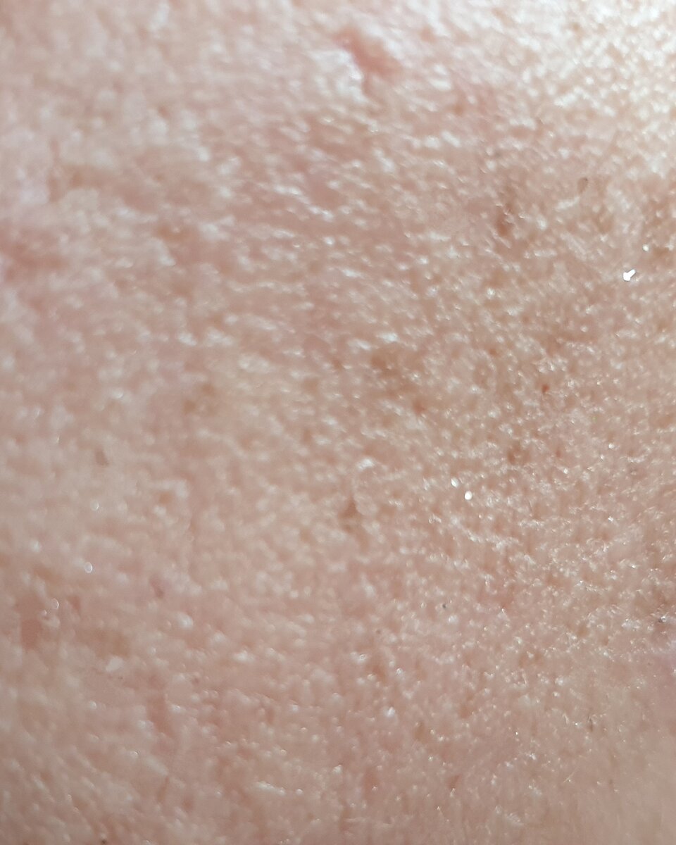 Макро, пигментация пятнышки. Бесят