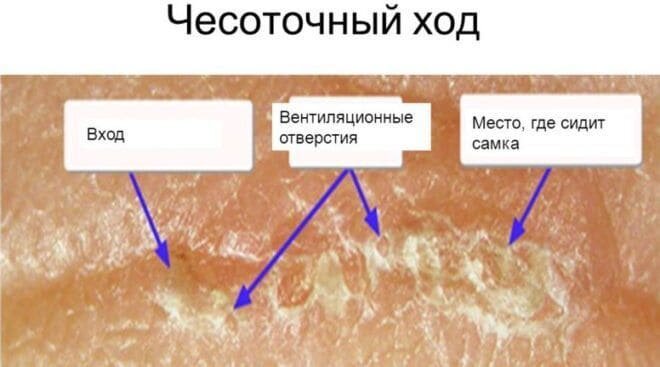 Чесотка -Причины, виды и лечение -Данные 