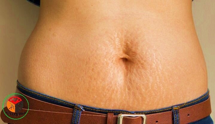 Растяжка на коже