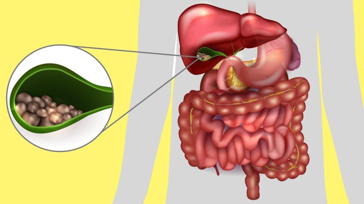 Камни в желчном пузыре. Источник Яндекс. Картинки