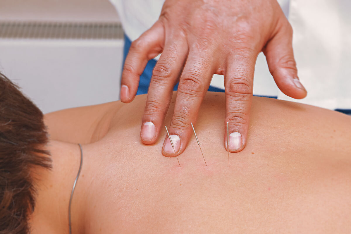 Иглоукалывание в клинике «Тибет»