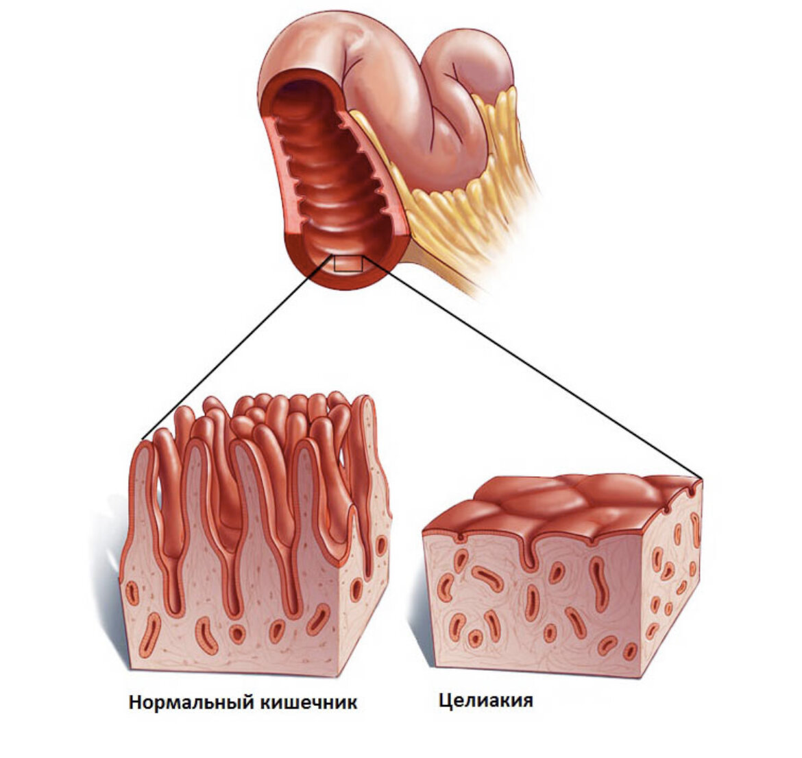 Слизистая оболочка 12 кишки. Целиакия кишечная энтеропатия. Целиакия тонкий кишечник.