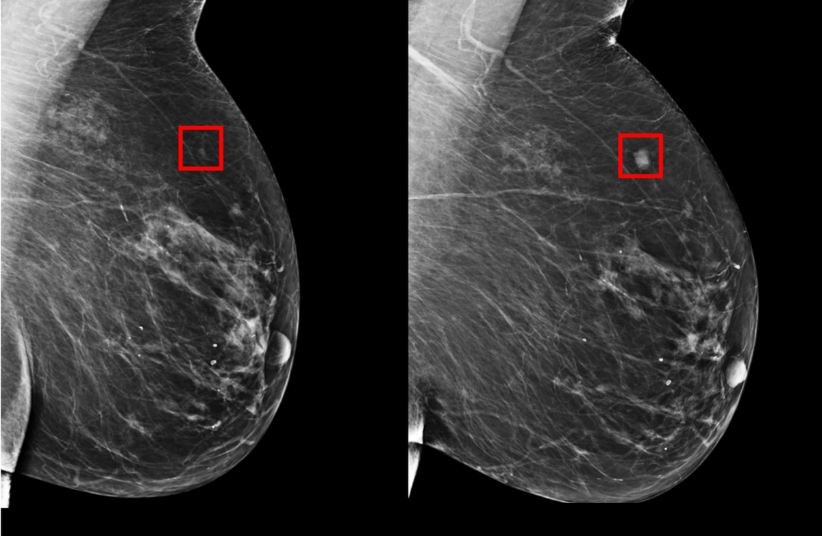 злокачественная опухоль в груди у женщин фото 36