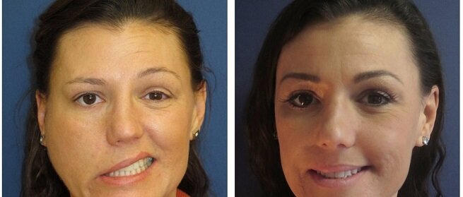 [caption id="attachment_2331" align="aligncenter" width="655"] Варианты искажения лица при недуге[/caption]