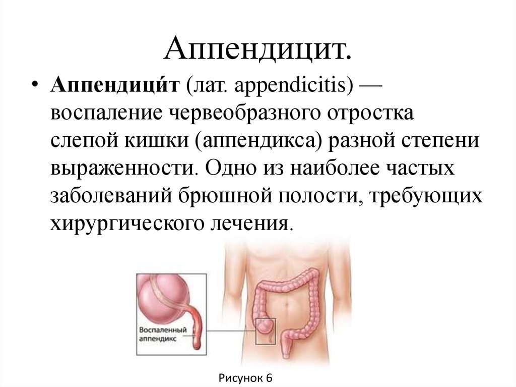 Источник:https://www.kleo.ru/items/zdorovie/appendichit-kak-bolit.shtml