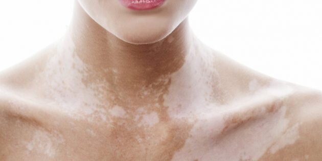 Так выглядят пятна при витилиго 