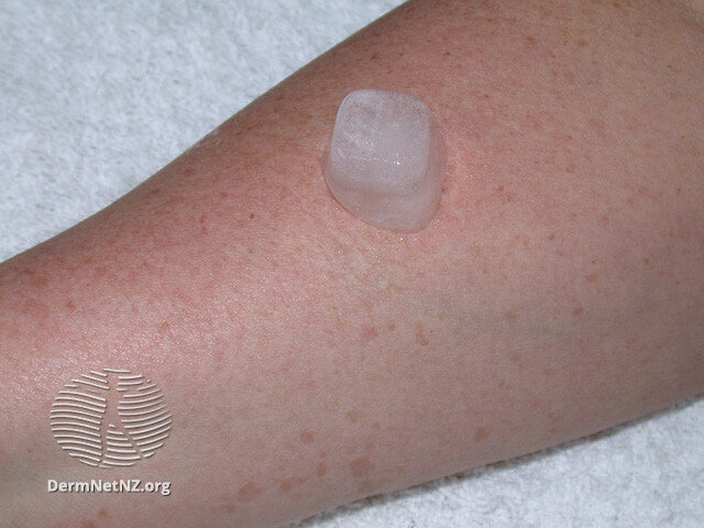 Лёд наносится на нормальную кожу (фото из dermnetnz.org)