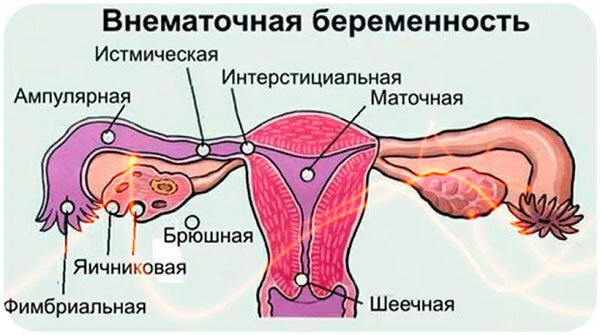 Внематочная беременность после ЭКО