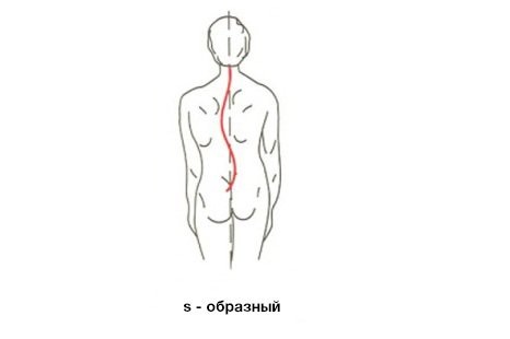 Характеризуется искривлением позвоночного столба по двум дугам, направленным в разные стороны. 