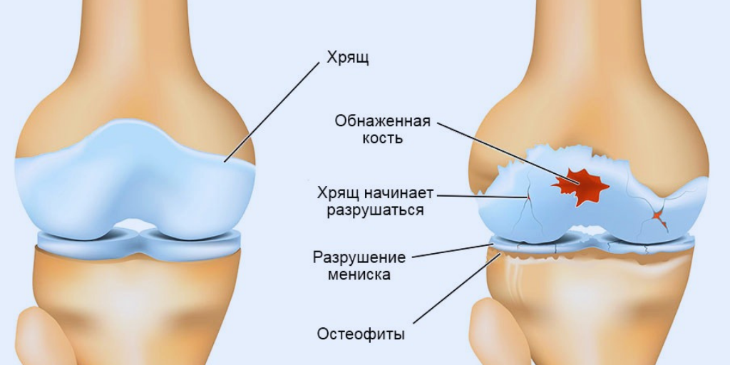 Остеофиты коленного сустава