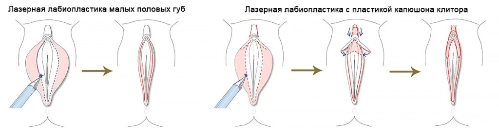 Гипоплазия половых губ | Центр Дикуля