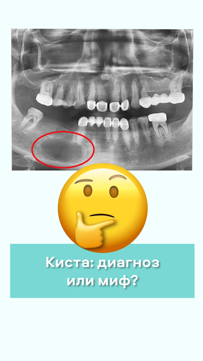 Пациент пришёл к врачу-стоматологу и говорит: «Мне доктор сказал, что у меня киста, и зуб надо удалять😱». 
Если Вас постигла такая участь, то прежде чем удалять зуб - прочтите эту статью! 
Рассказывает врач стоматолог-терапевт Бест Клиник Белова Марина Александровна:

🦷Что же такое киста? Киста (от греческого - пузырь) - это патологическая полость в тканях и органах, имеющая стенку (эпителиальную выстелку) и содержимое.
Микробы из канала зуба через апикальное (верхушечное) отверстие корня попадают в кость челюсти, и клетки иммунной системы нашего организма начинают борьбу с врагами. В результате этой борьбы наши клетки защитники не только убивают врагов-микробов, но и разрушают нашу же кость челюсти. 

🦷И на рентгеновском снимке мы видим темное пятно вокруг корня, который говорит о том, что рентгеновские лучи свободно проходят в этом месте. Их ничто не задерживает, потому, что кости здесь нет. 

🦷Но эпителиальные клетки не рентгеноконтрастны! Их можно увидеть только на гистологическом препарате под микроскопом. Поэтому уже более 20 лет назад диагноз «Киста» убран из клинического использования. Наличие эпителиальной выстелки действительно требует хирургического вмешательства (или резекции верхушки корня, или удаление зуба).

🦷Но, то, что доктор видит на R-снимке - это только разряжение костной ткани. И в этой ситуации лучшим помощником зубу будет стоматолог-терапевт с микроскопом. Только в том случае, когда при наблюдении в динамике после консервативного лечения размер резорбции кости увеличился или есть болевые ощущения, решаем вопрос о хирургическом лечении вплоть до удаления зуба.

🦷Так что, когда стоматолог поставил вашему зубу диагноз «Киста» и вынес ему смертный приговор, не спешите зуб удалять. Найдите стоматолога-терапевта с микроскопом и послушайте его мнение. И вам удасться и сохранить ваши зубы. Берегите свое здоровье и не торопитесь действовать в сомнительных случаях!
